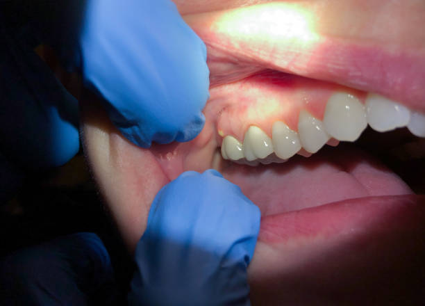 Best Emergency Treatment for Dental Infections or Abscesses in Bowie, TX